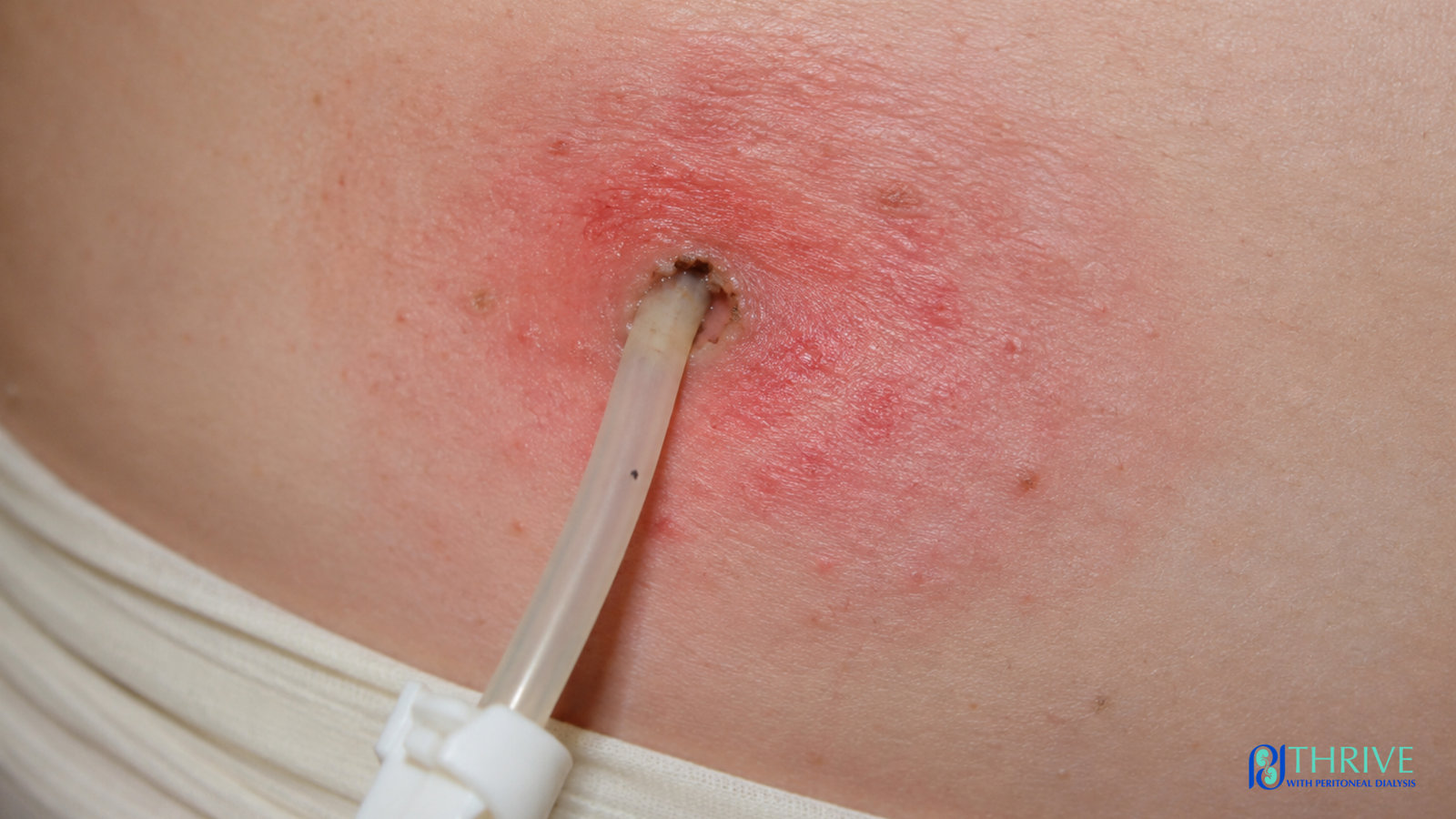 PD-exit-site-infection